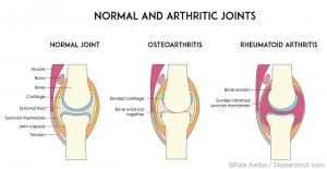 National Arthritis and Osteoporosis Awareness Month: Arthritis vs. Osteoporosis