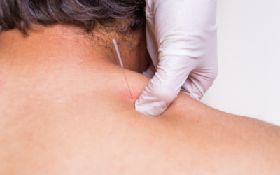 What is dry needling physical therapy?